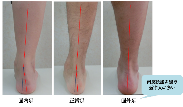 足首の内側側副靭帯損傷 三角靱帯損傷 について ぷれふぁ